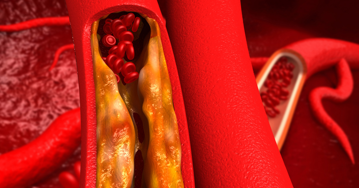 main cause of arteriosclerosis